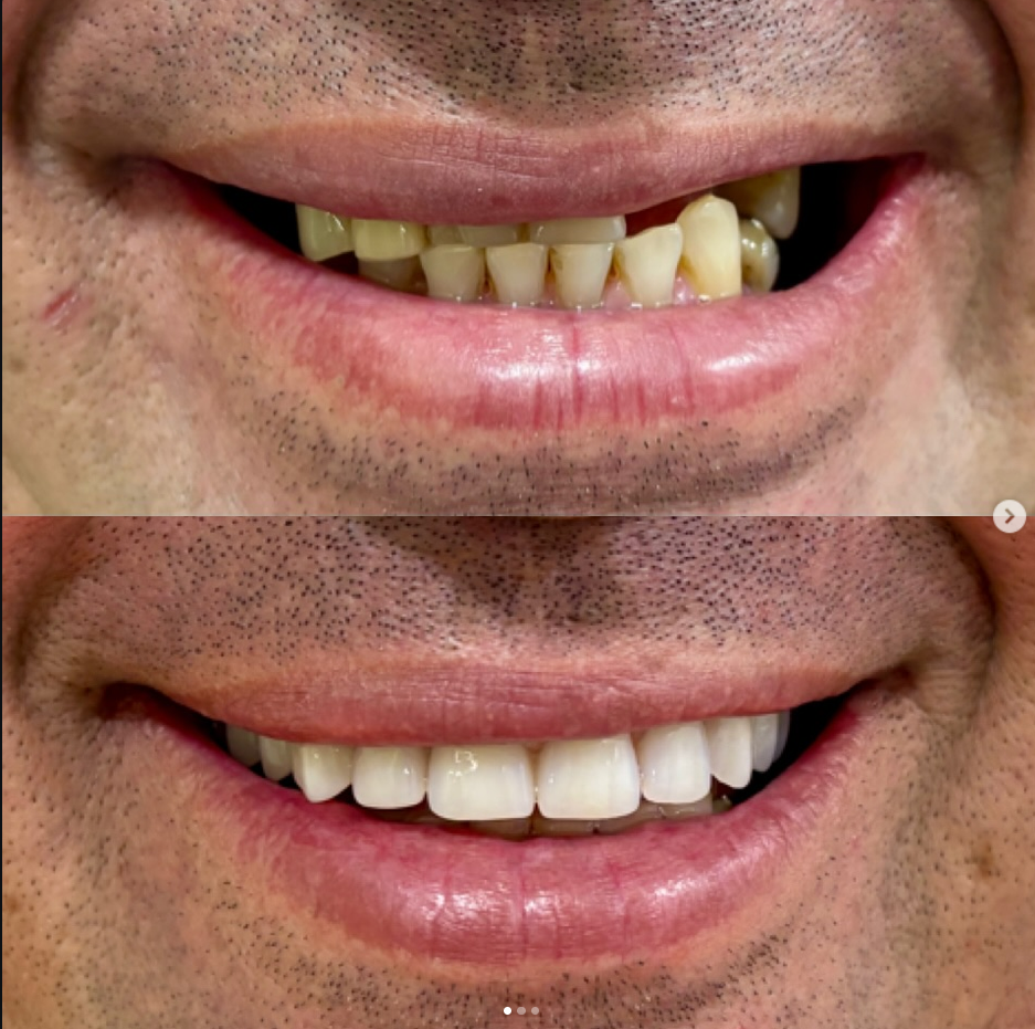 Registro clínico de sorriso antes e depois do tratamento