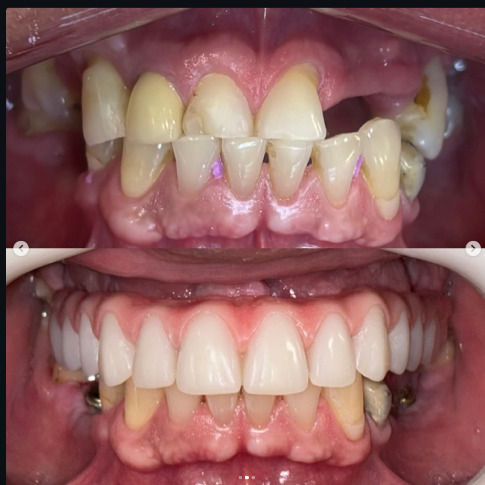 Registro clínico relacionado a implante dentário